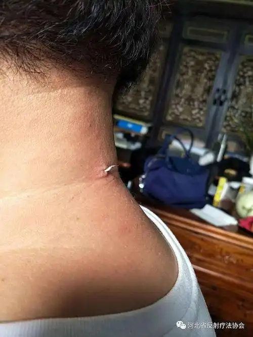 净派挑羊毛疔技术交流会-在线订票-互动吧