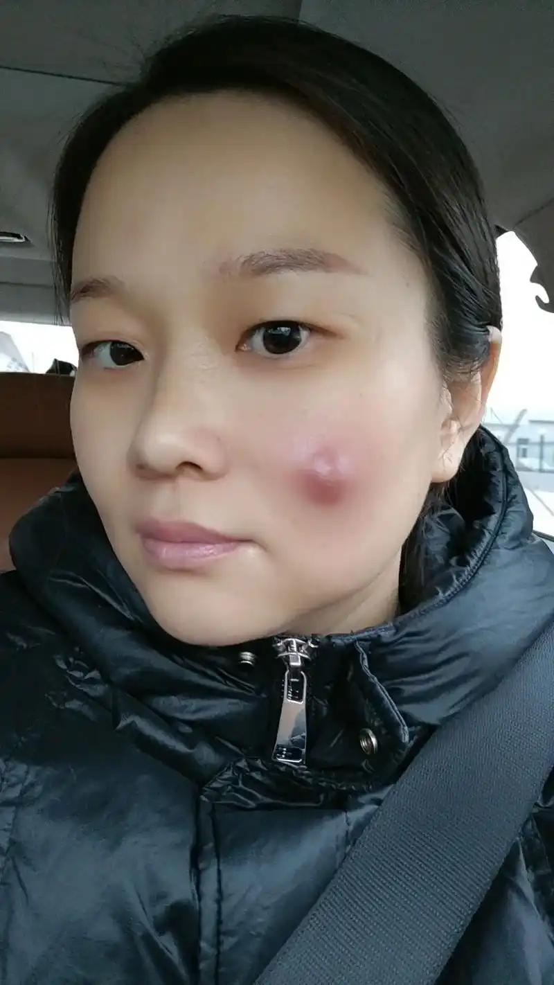 这叫火疖子,大夫 - 抖音