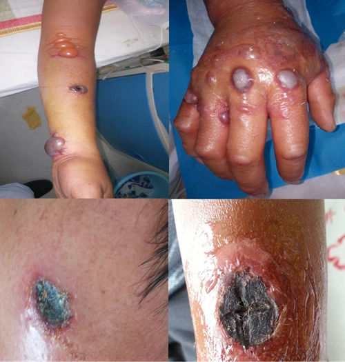 炭疽有什么症状?