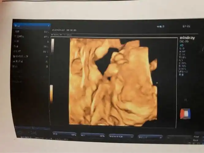 四维照片宝宝这样算兔唇吗