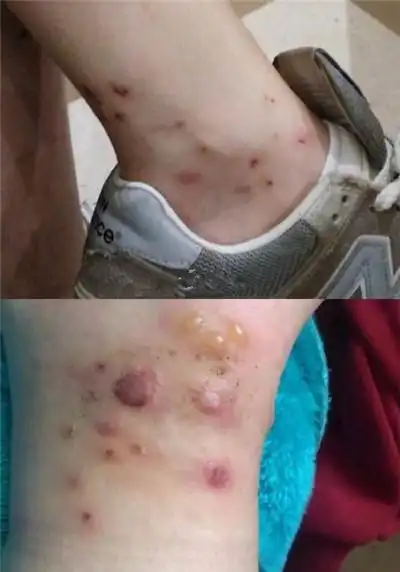 【图】林妙可被毒虫咬伤令人怜惜 小小年纪不畏艰苦坚持演戏获赞