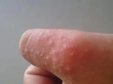 夏天手上容易长小水泡,该怎么办?