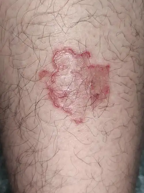 28岁小伙子出现体癣,花瓣样红斑竟是疾病信号!