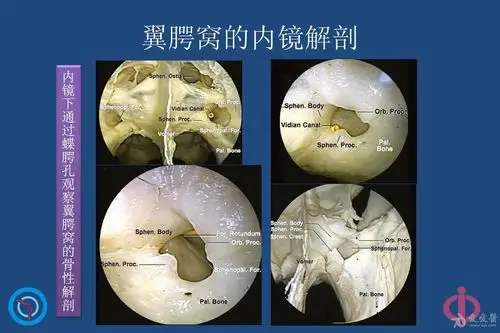 专业资源翼腭窝的解剖影像和临床