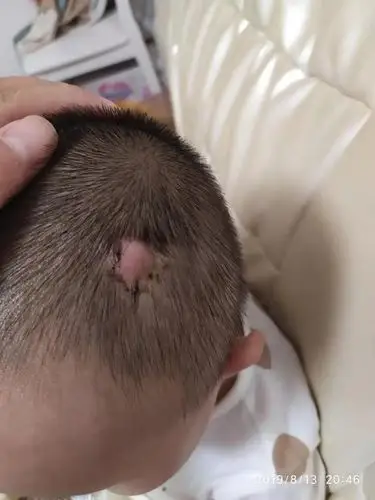 2岁半的宝宝头上长了一个包,1个月了,还不见消下去,谁能看看什么原因