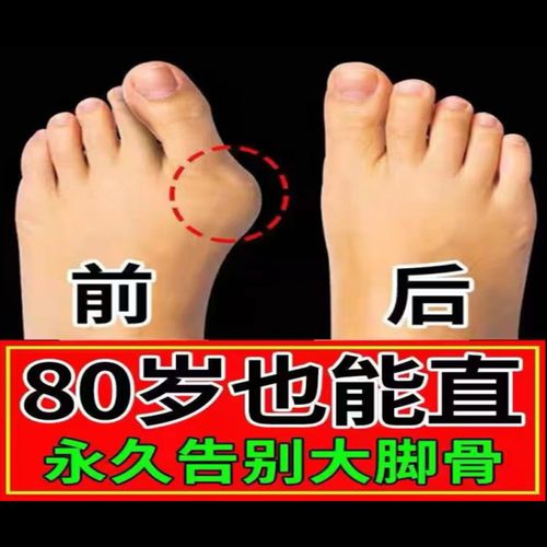 【丑脚专用】拇指外翻矫正器脚趾重叠疼痛脚趾矫正器大脚骨专用贴