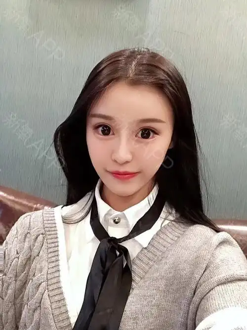 成都眼部综合好不好_效果图_大眼萌妹氧气眼部综合术后第104天_新氧