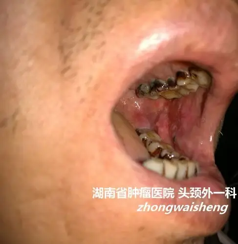 治疗是以手术为主,晚期患者则需要根放疗和化疗以减少肿瘤复发的风险