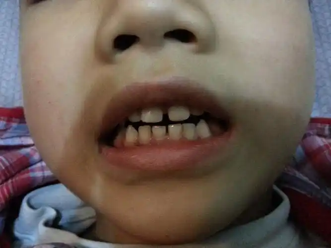 6岁半小孩乳牙自己移动,是里面长新牙了吗?