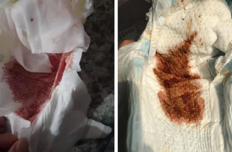 宝宝一阵一阵哭闹小心是肠套叠_肠套叠_发病原因_症状表现_检查_治疗