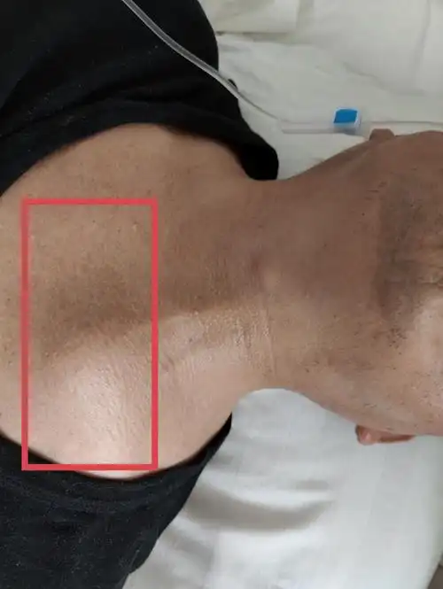 经常腰痛驼背!小心强直性脊柱炎