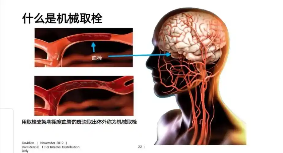 其它 预防为主 远离卒中 写美篇如果确诊为急性脑卒中,应尽快开展溶栓