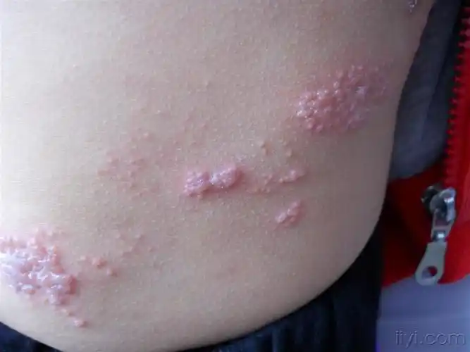 典型病例小儿带状疱疹