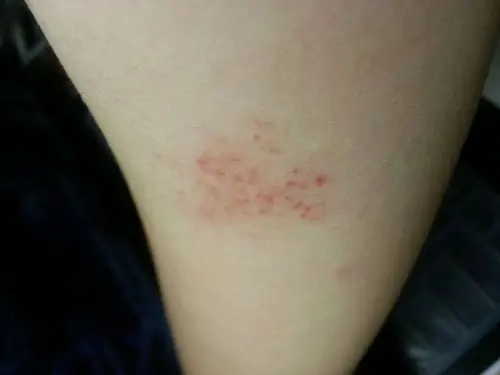 最近皮肤没有被蚊子咬也会起红斑是什么原因?