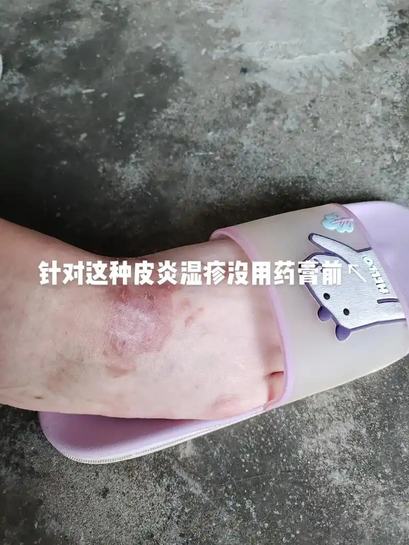 祖传治疗皮肤玩固痒皮炎湿疹癣上面是一个病号用的三天的效果