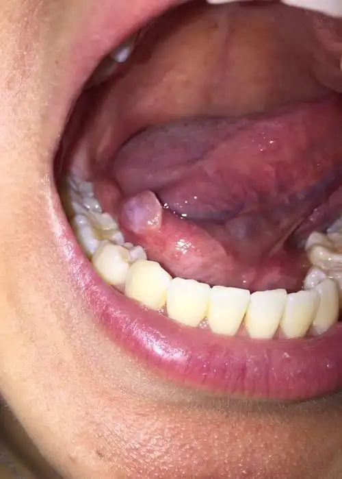 请问我这个是舌下囊肿吗?