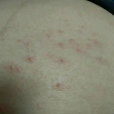 昨天洗的澡,今天发现肚子上面起了这麼多的小红疙瘩,不碰的时候什麼