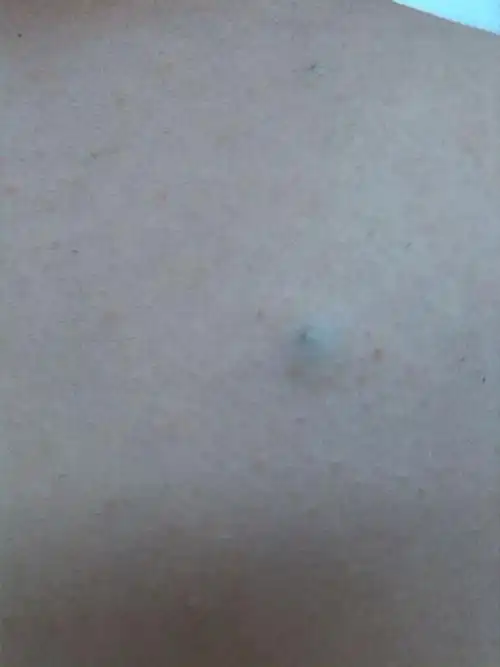 耳朵后边的皮脂腺囊肿图片