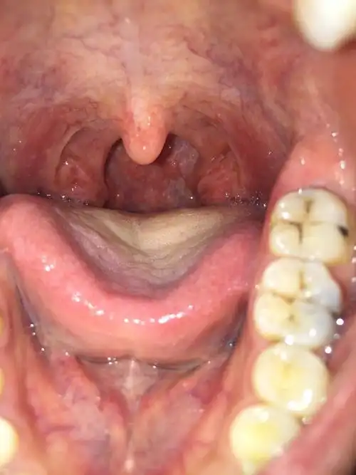 喉咙左边的坨比右边的多大好多,后面还有一坨小肉和