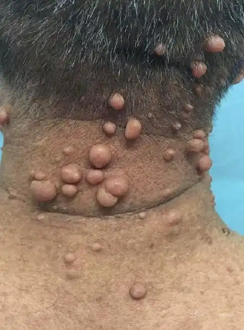 知识分享神经纤维瘤病