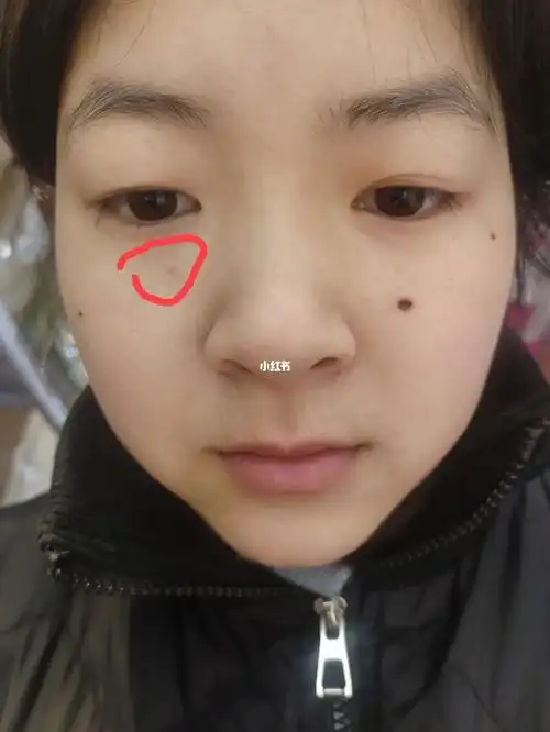 药水点痣第十八天