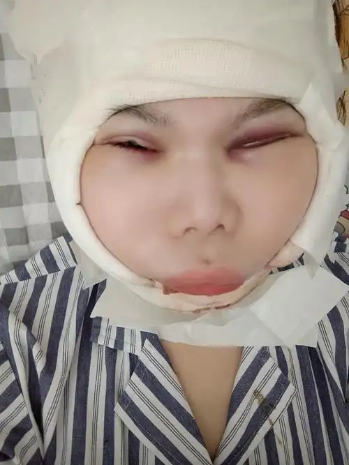 选的全麻,手术全程不含麻醉时间1.5小时左右.术后_圈子-新氧美容整形