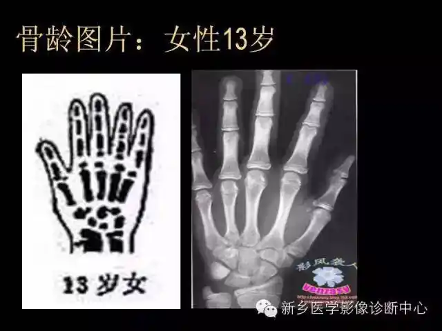 女生骨龄怎么看?出生到成年