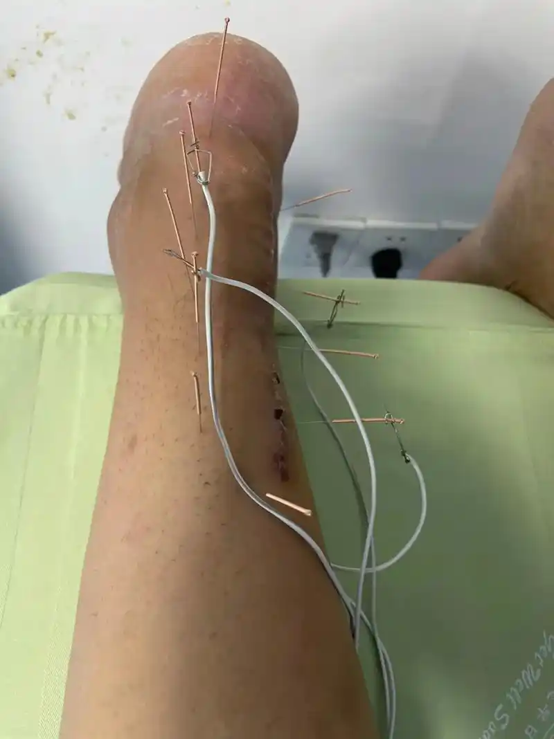 术后康复 #中医针灸#难熬的日子终 - 抖音