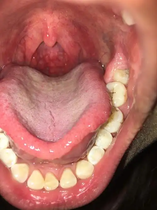 我的嗓子总是起红泡泡,麻烦行家看看这个怎么治.吃药打针都没用.