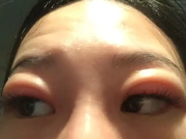 有不少病人的第一症状是"晨起后双眼皮肿胀",这种症状是肾脏出现问题