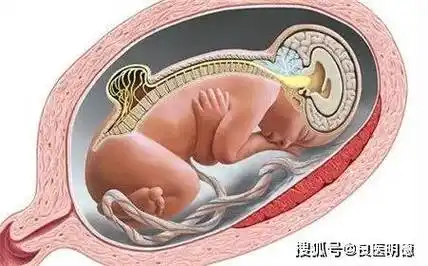 连体严重先心病先天愚型儿开放性脊柱裂严重脑膨出无脑儿九种重度畸形