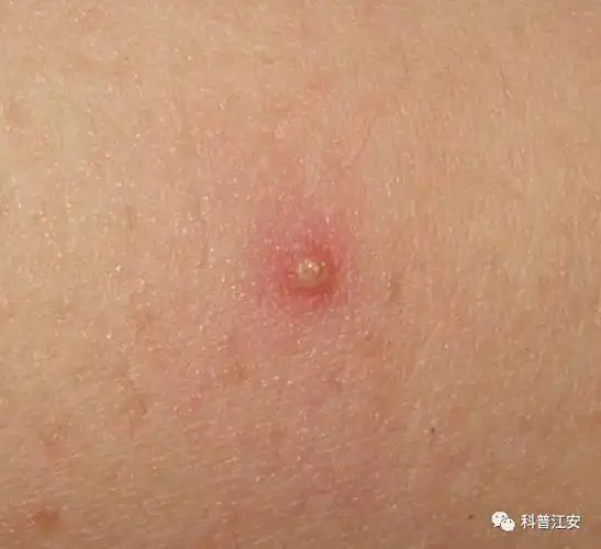 毛囊炎皮脂腺囊肿形成后,一般难以自行消退.