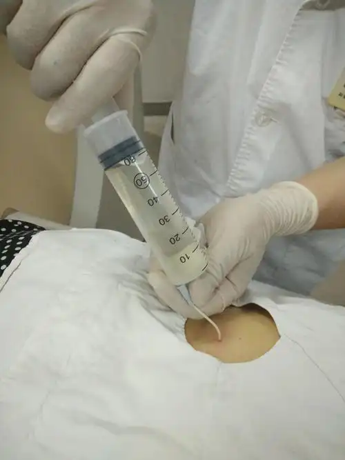 ct引导下肾囊肿经皮穿刺抽吸硬化治疗 - 好大夫在线