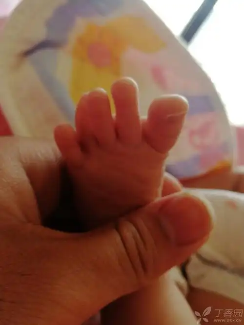 新生儿脚趾畸形
