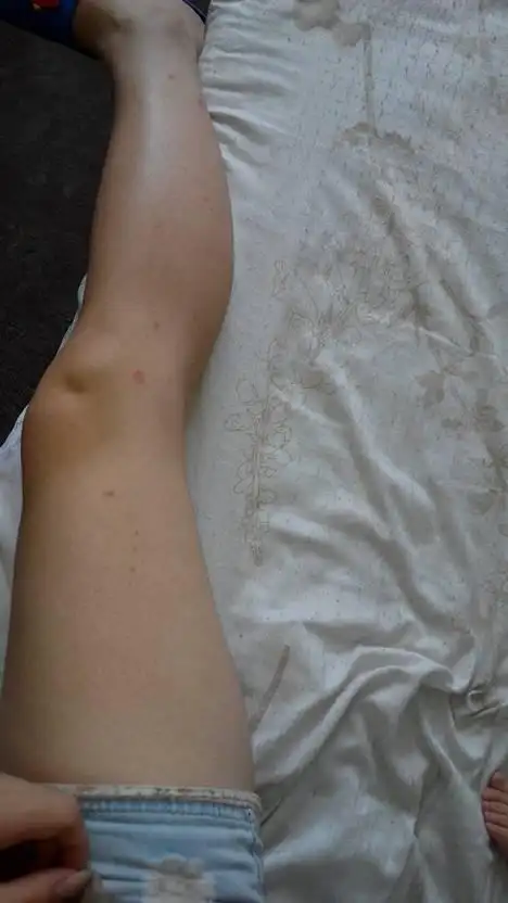 蟑螂太多,怎样除掉,家里卫生还可以就是蟑螂也会咬人,脚都咬毁容了.