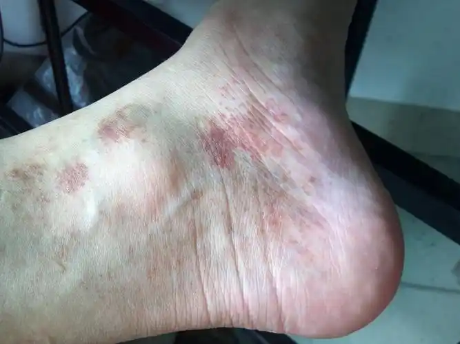 脚面上长红色斑块