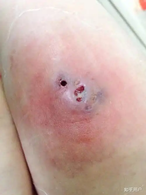 人体的火疖子 (化脓性毛囊及毛囊深部周围组织的感染) 能有多大?