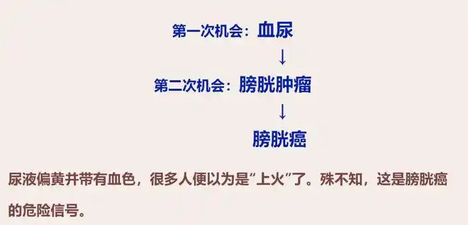 警惕膀胱癌的四大症状