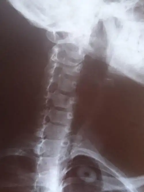 24岁颈椎骨质增生