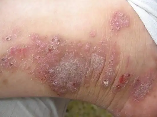 湿疹图片和症状 (50)