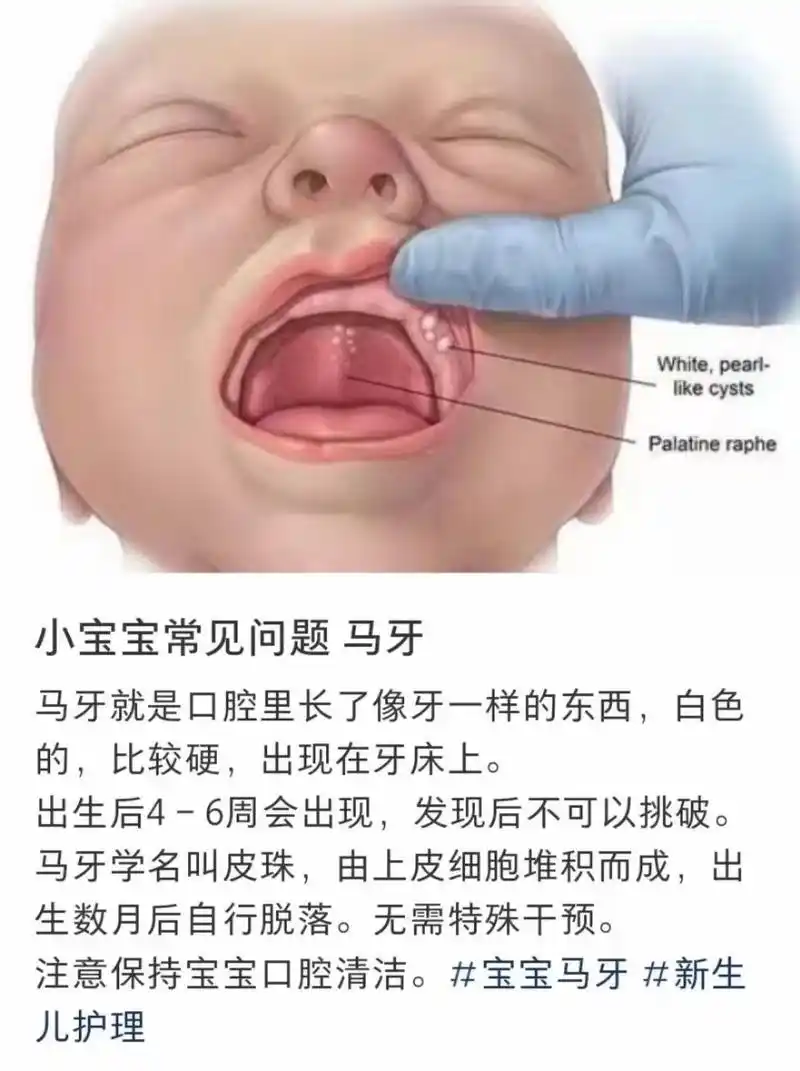六个月宝宝牙床上长个肉疙瘩图片