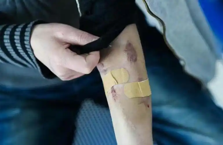 卖花盲女住厕所旁透析6年胳膊扎几千针眼仍不放弃