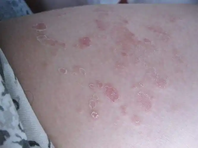 背后体股癣图片_有来医生