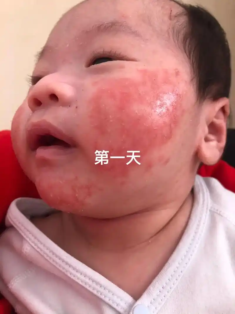 宝宝湿疹 正能量感谢大家的热情建议,宝宝脸上终于好了很多. - 抖音