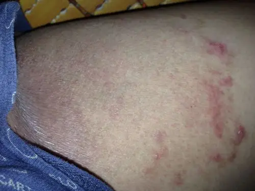 看图我这个是股癣么?好可怕皮肤病,越来越大了!