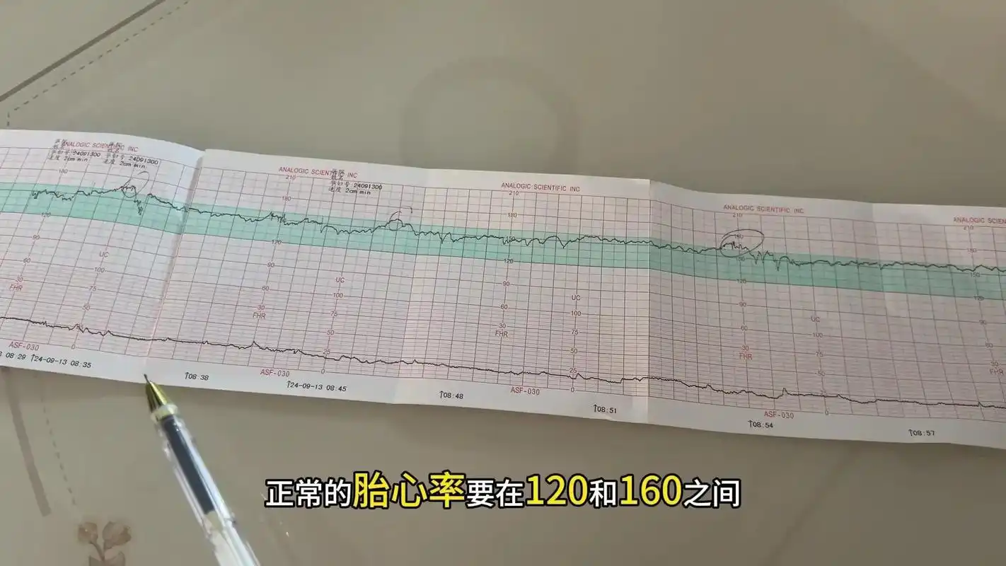 99996900胎心监护图解析.96两