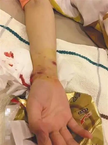 李玲玲在网帖中配图显示,她的手被狗咬的都是血.受访者供图