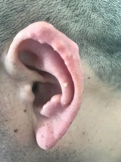 风湿免疫病的皮肤表现