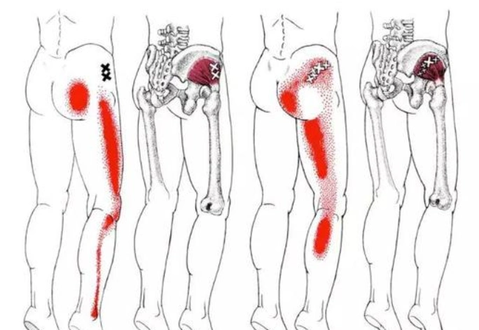 运动后屁股疼?看看你是哪种情况?山大二院殷庆丰教授来解说 - 哔哩哔