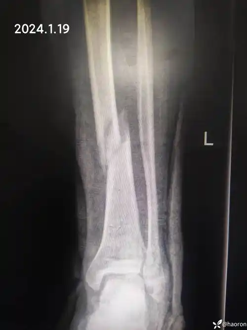 胫腓骨骨折保守治疗一月复查下步处理